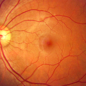 New trial for blindness rewrites the genetic code