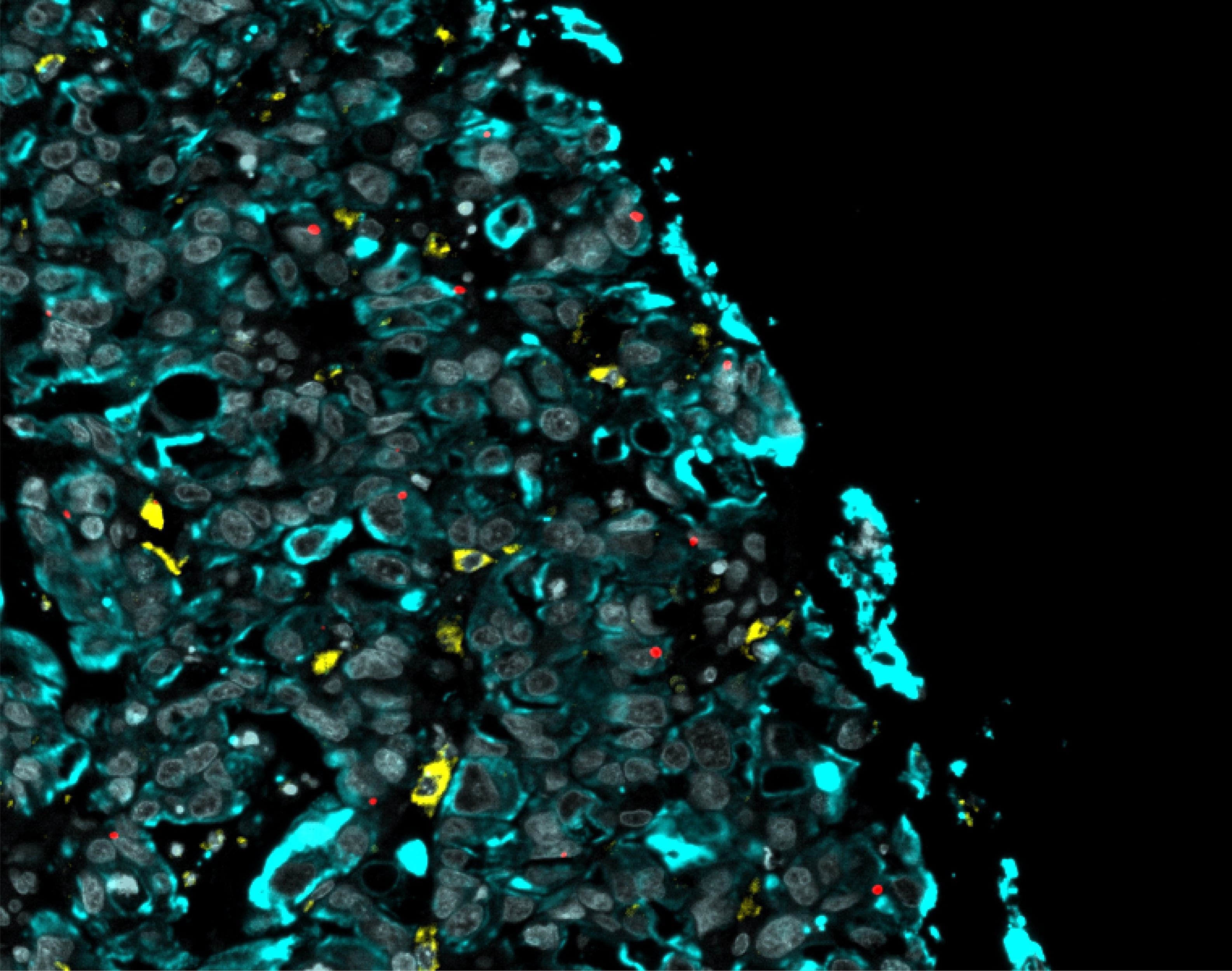 New research reveals why some oesophageal cancers are so hard to treat