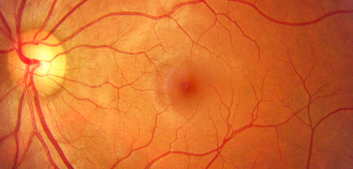 New trial for blindness rewrites the genetic code