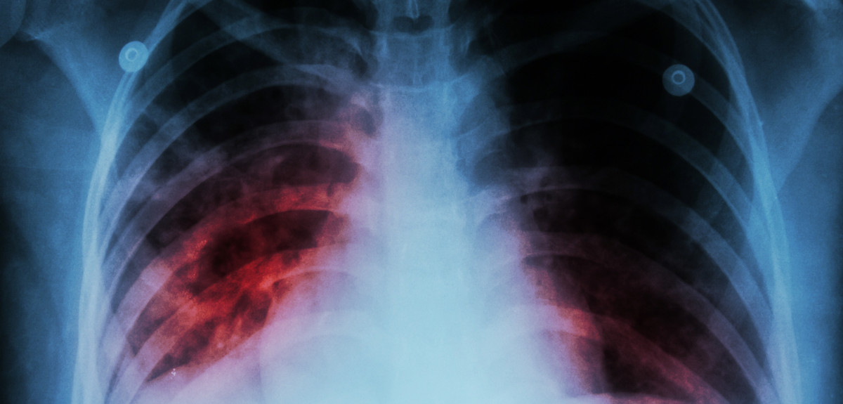 Biomarker discovery offers hope for new TB vaccine