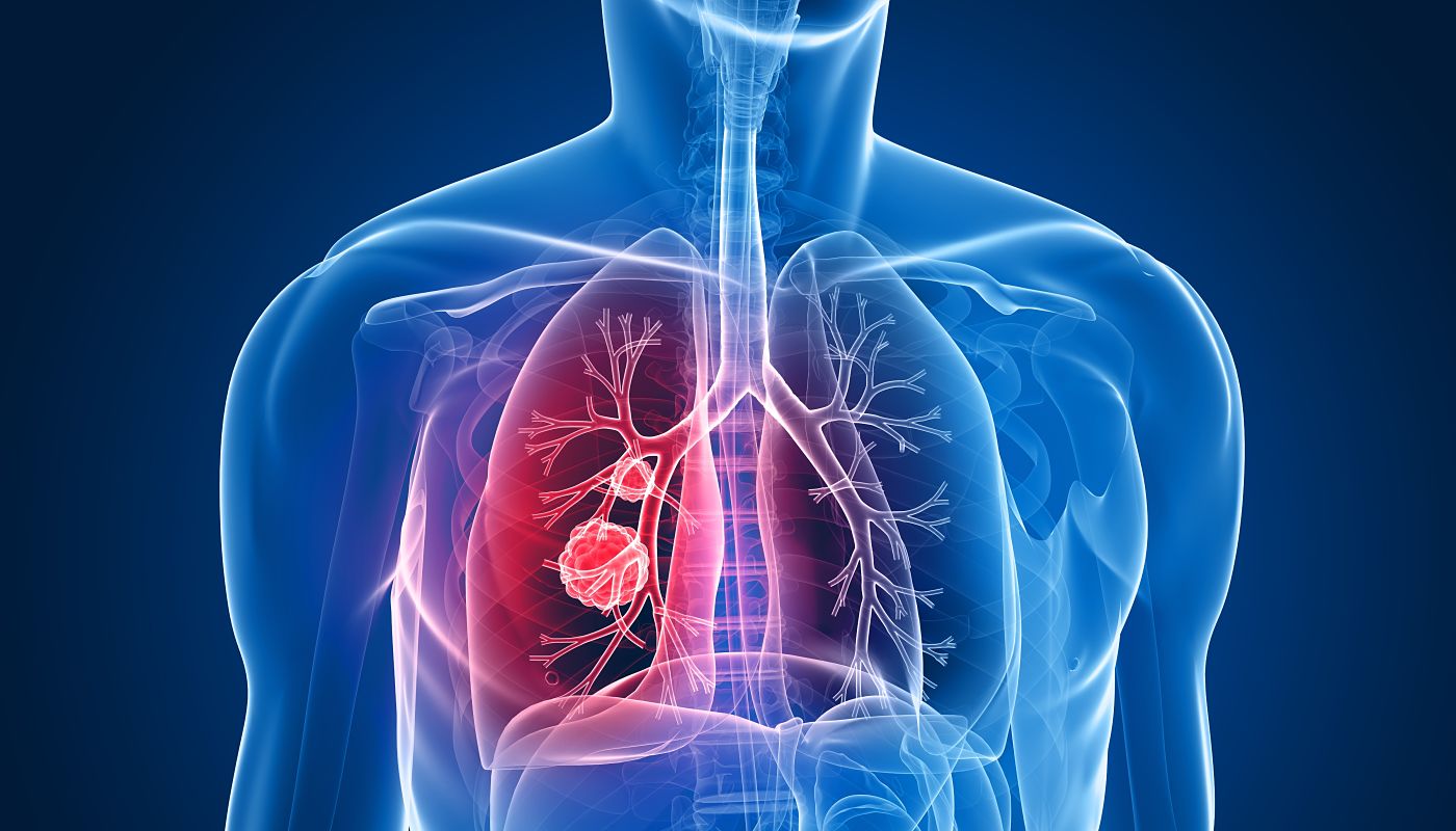 Genetic expression 'predicts lung cancer survival'