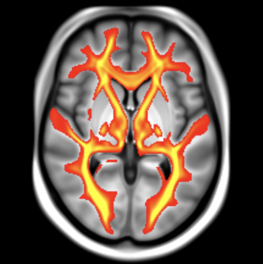 MRI scan of the brain showing white matter