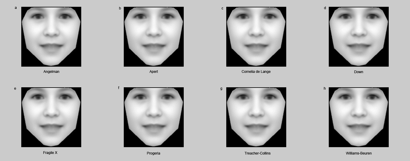Average facial features for eight syndromes become clear from computer analysis of photos