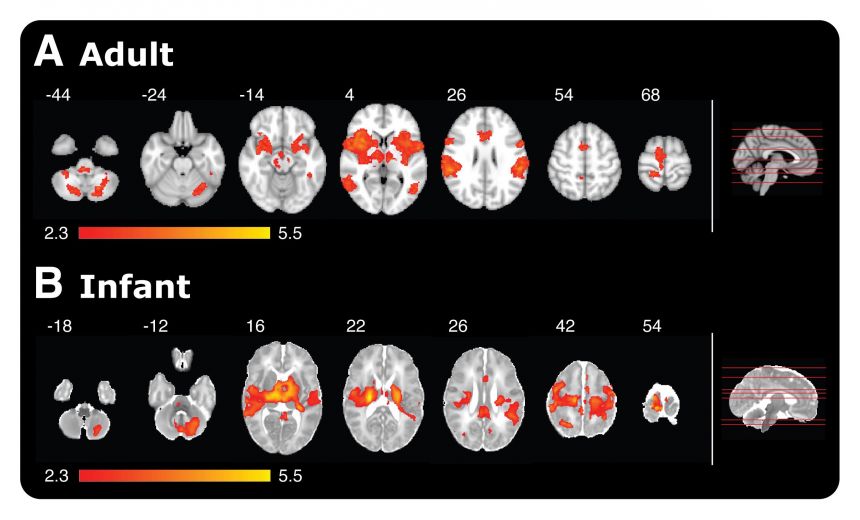 Magnetic Resonance Imaging (MRI) giving a comparison of brain activity in adults and babies when poked with a special retracting rod simulating a sensation of pain.