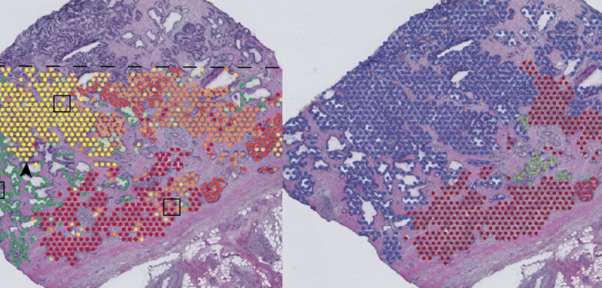 Genetic mapping of tumours reveals how cancers grow