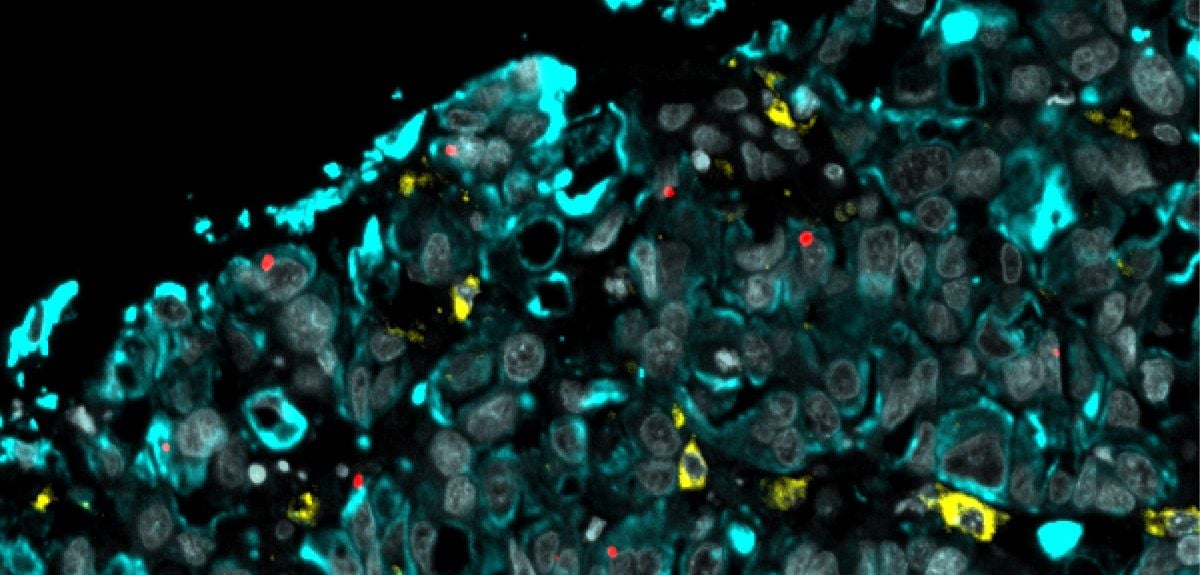 Oesophagal adenocarcinoma