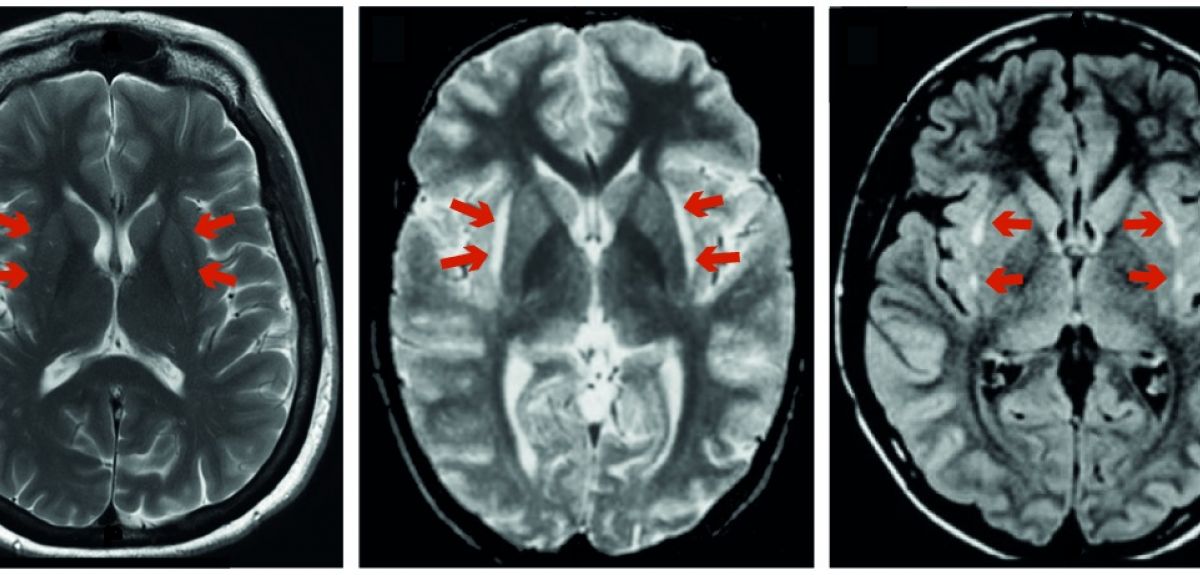 Little understood brain region linked to how we perceive pain