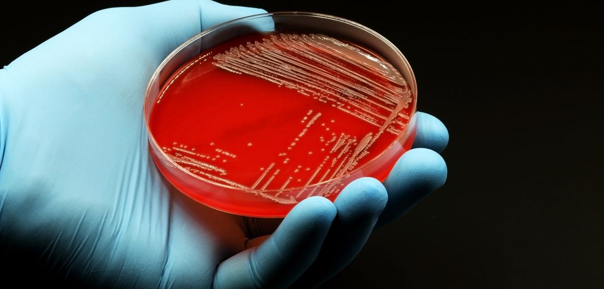 A hand in a latex glove holding a petri dish with red agar medium that has a culture of the bacteria Methicillin-resistant Staphylococcus aureus (MRSA) growing on it.