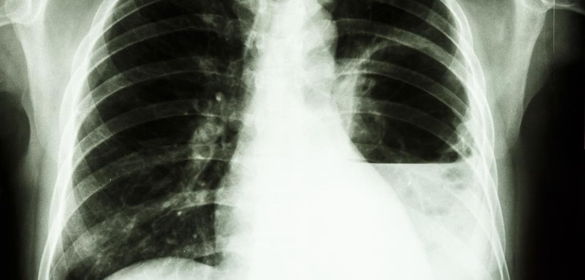 Film X-ray shows left lung abscess from Burkholderia pseudomallei infection (Melioidosis)