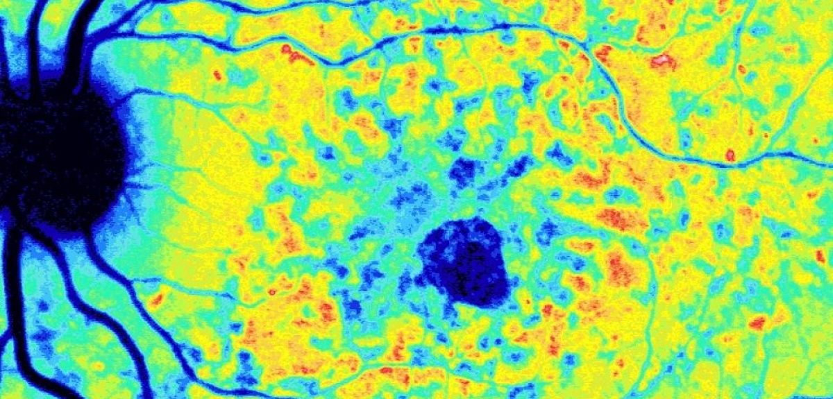A heatmap coloured image of Stargardt disease