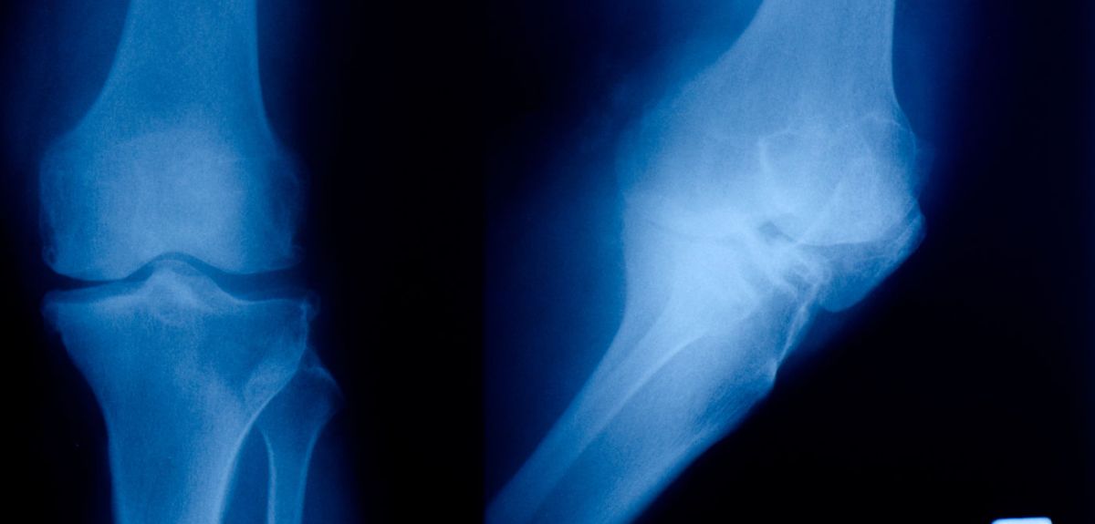 X-ray showing osteoarthritis of the knee