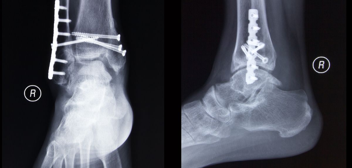 Укладка голеностопного сустава. Перелом наружной латеральной лодыжки рентген. Изолированный перелом лодыжки рентген. Чрезсиндесмозный перелом лодыжки. Перелом Мальгеня лодыжки.