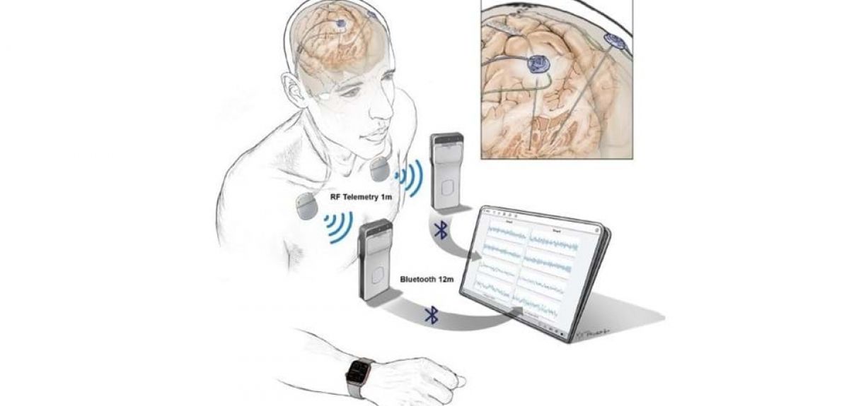 Illustration of new generation of neurostimulation devices
