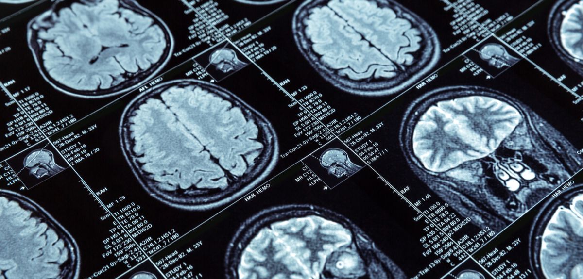 MRI scans of the brain
