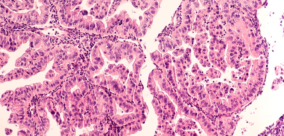 Ovarian cancer cells under a microscope