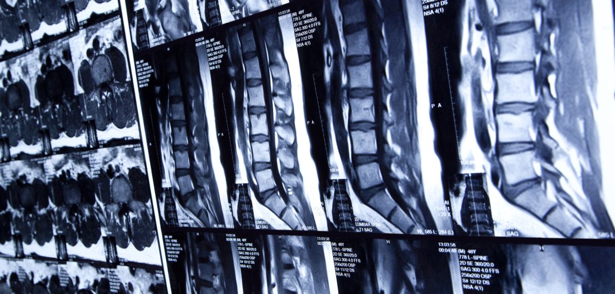 First UK spine fracture patients identified by NHS-X and Nanox.AI Artificial Intelligence research study