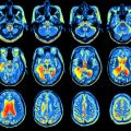 First genetic analysis of brain function and structure using UK Biobank imaging data yields exciting results 
