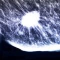 Mammogram showing breast cancer tumour