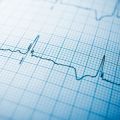 AI technology used to predict heart attacks