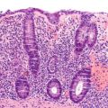 Single cell analysis paves the way for better treatments for IBD