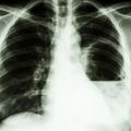 Film X-ray shows left lung abscess from Burkholderia pseudomallei infection (Melioidosis)