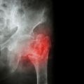 Image depicts an X-ray of a hip fracture