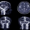 More awareness needed about stroke risk after mini-stroke