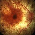 Gene therapy breakthrough in treating rare form of blindness