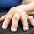 A woman's hand deformed by Rheumatoid Arthritis