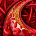 Atherosclerosis - blocked artery