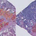 Genetic mapping of tumours reveals how cancers grow